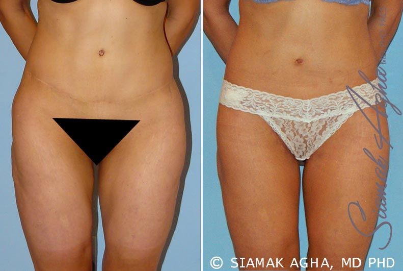 Lower Body Lift Before & After