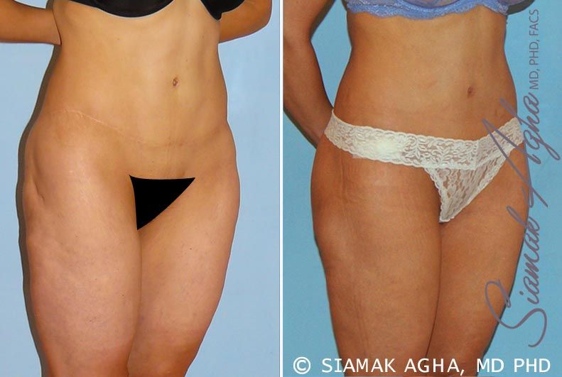 Lower Body Lift Before & After