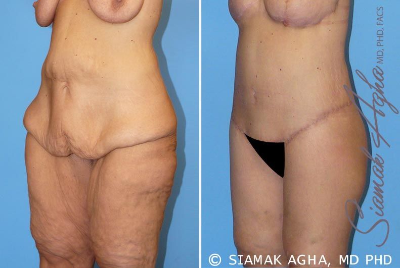 Lower Body Lift Before & After