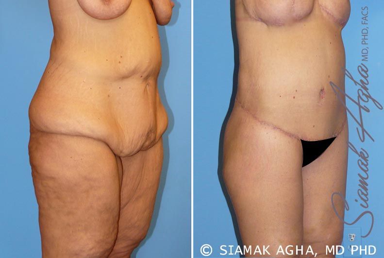 Lower Body Lift Before & After