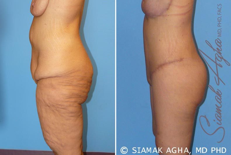 Lower Body Lift Before & After