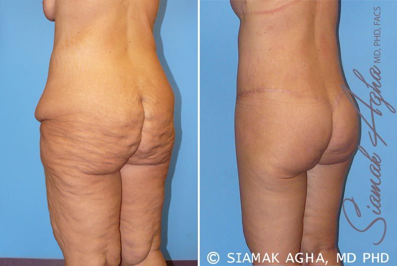 Lower Body Lift Before & After