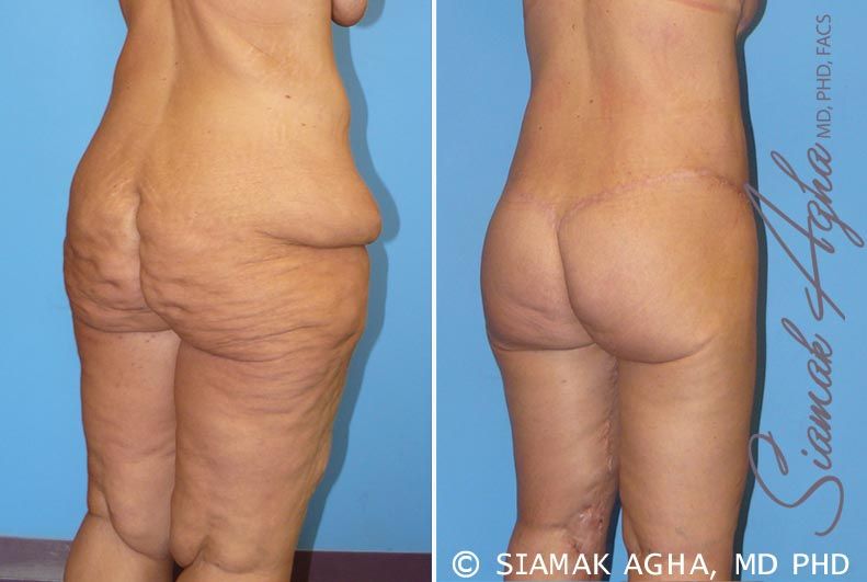 Lower Body Lift Before & After