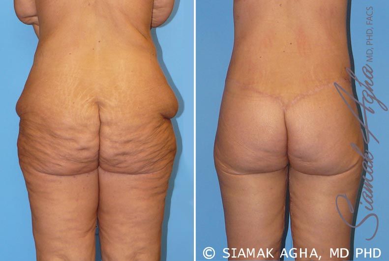Lower Body Lift Before & After