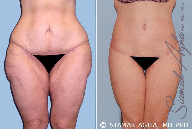 Lower Body Lift Before & After