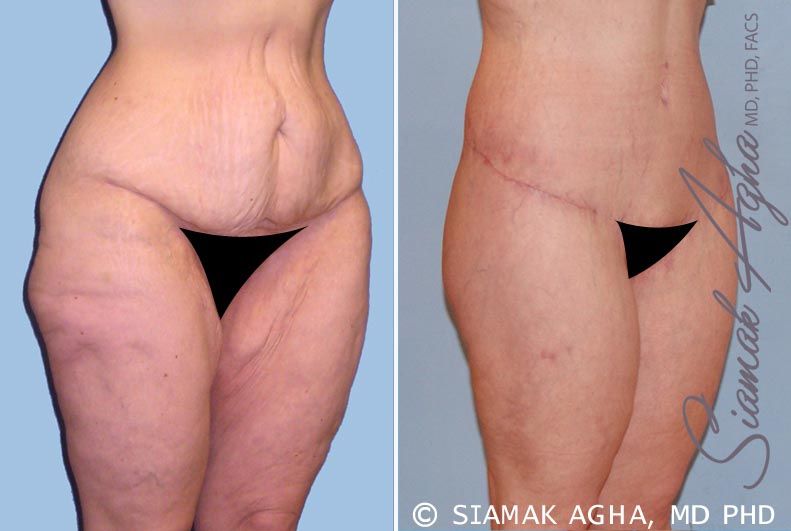 Lower Body Lift Before & After