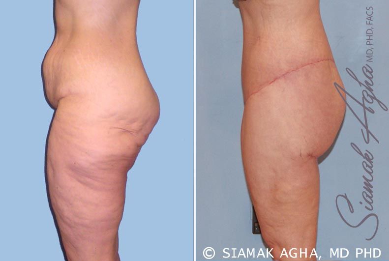 Lower Body Lift Before & After