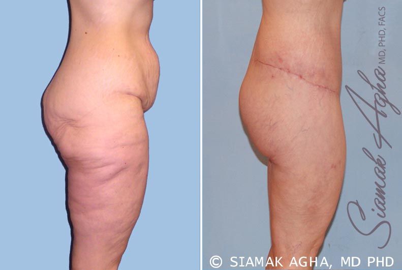 Lower Body Lift Before & After