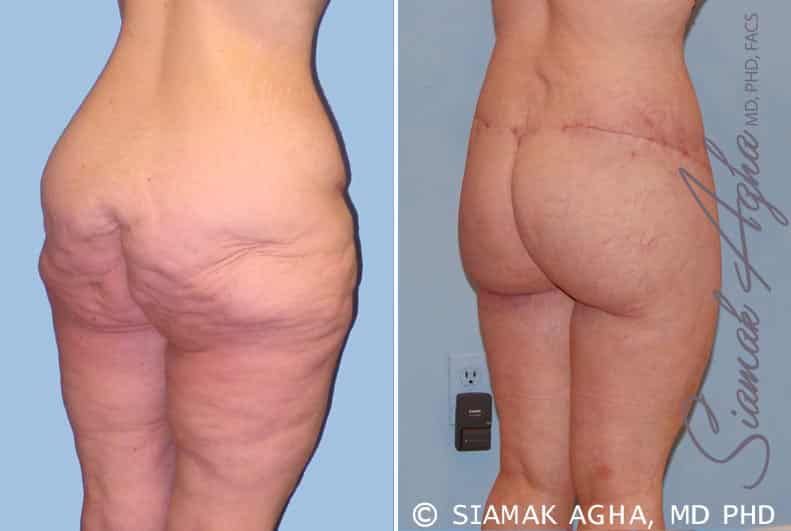 Lower Body Lift Before & After