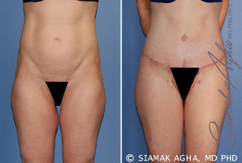 Lower Body Lift Before & After