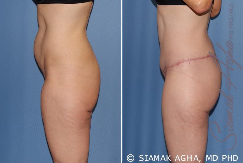 Lower Body Lift Before & After