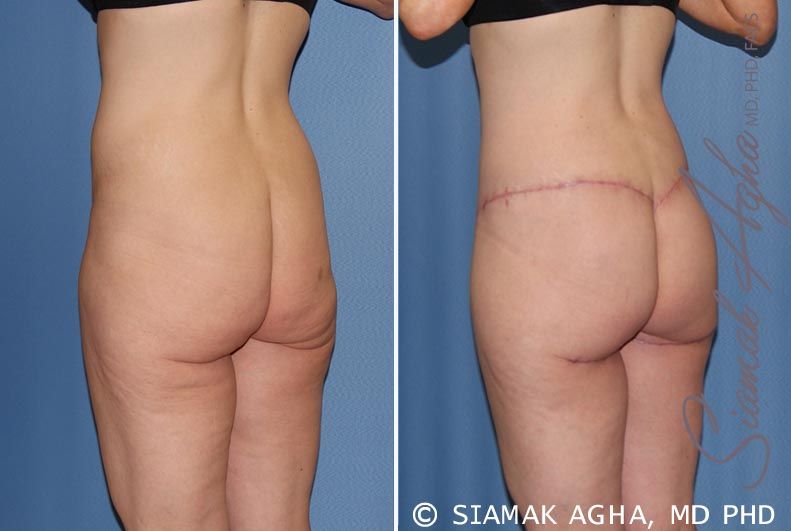 Lower Body Lift Before & After