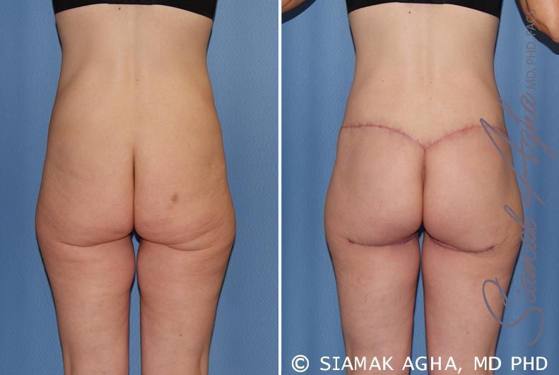 Lower Body Lift Before & After