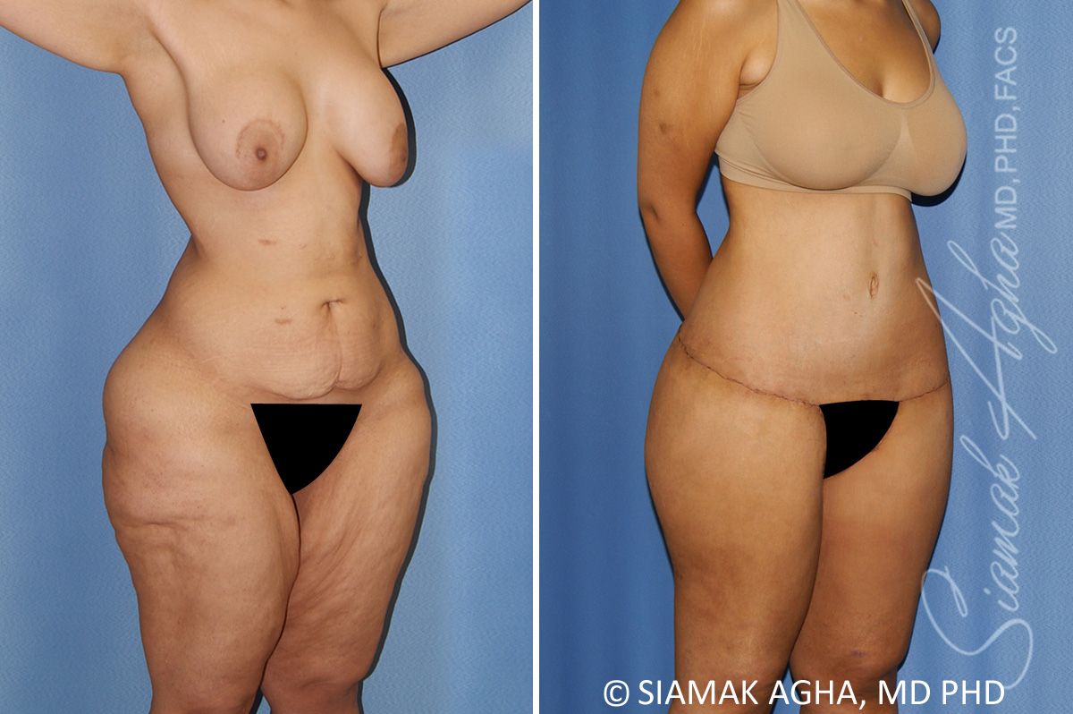 Lower Body Lift Before & After