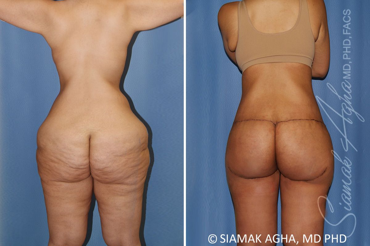 Lower Body Lift Before & After