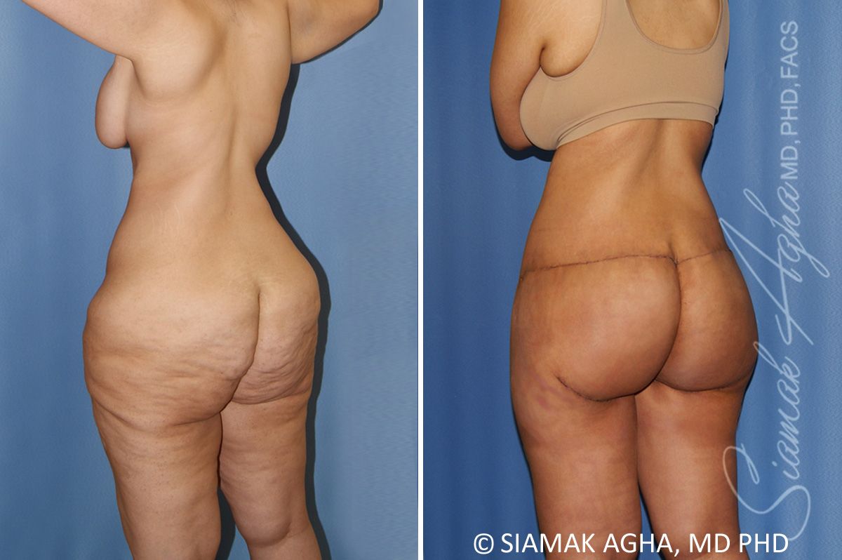 Lower Body Lift Before & After