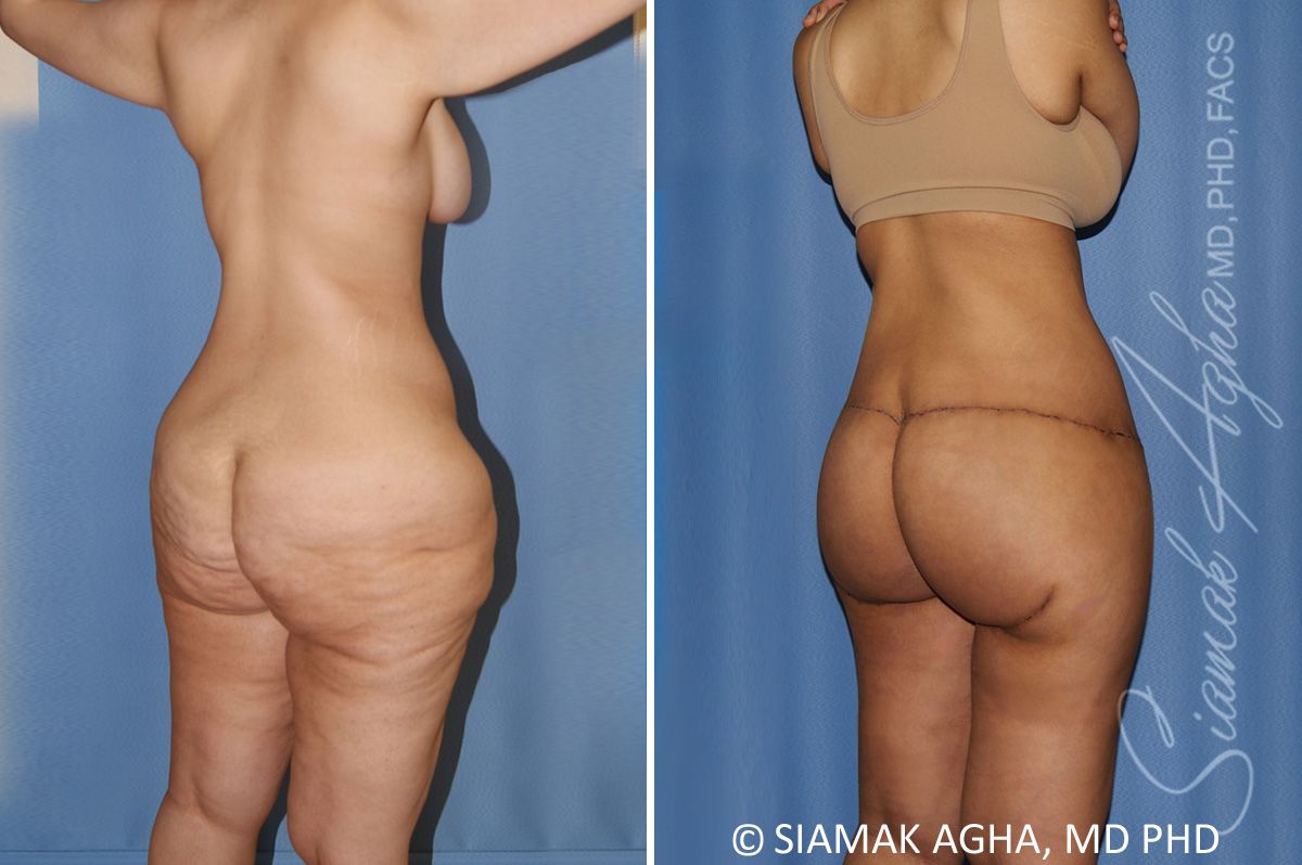 Lower Body Lift Before & After