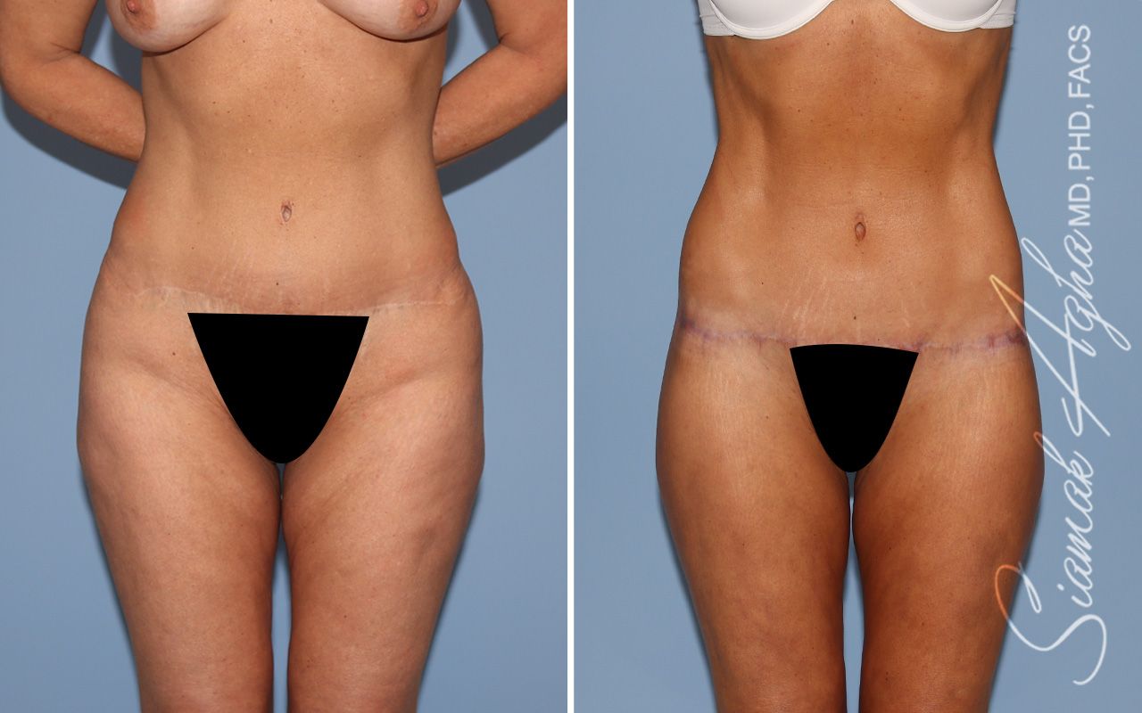 Lower Body Lift Before & After