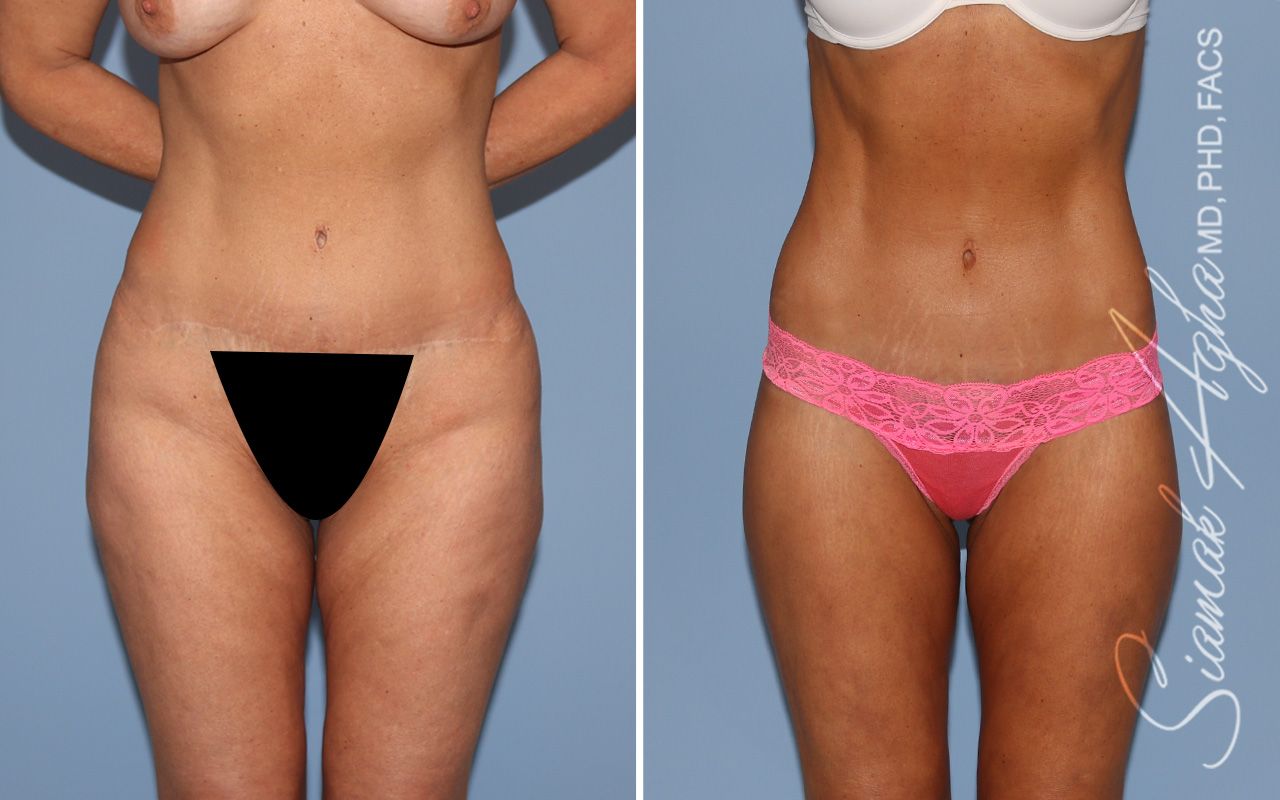 Lower Body Lift Before & After