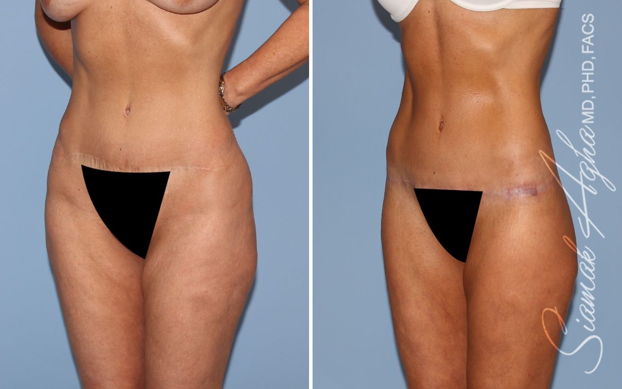 Lower Body Lift Before & After
