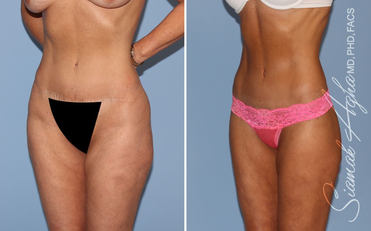 Lower Body Lift Before & After