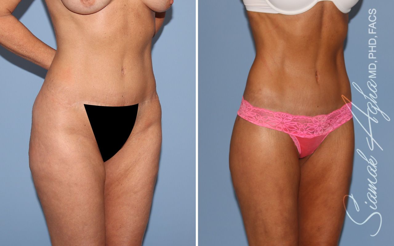 Lower Body Lift Before & After