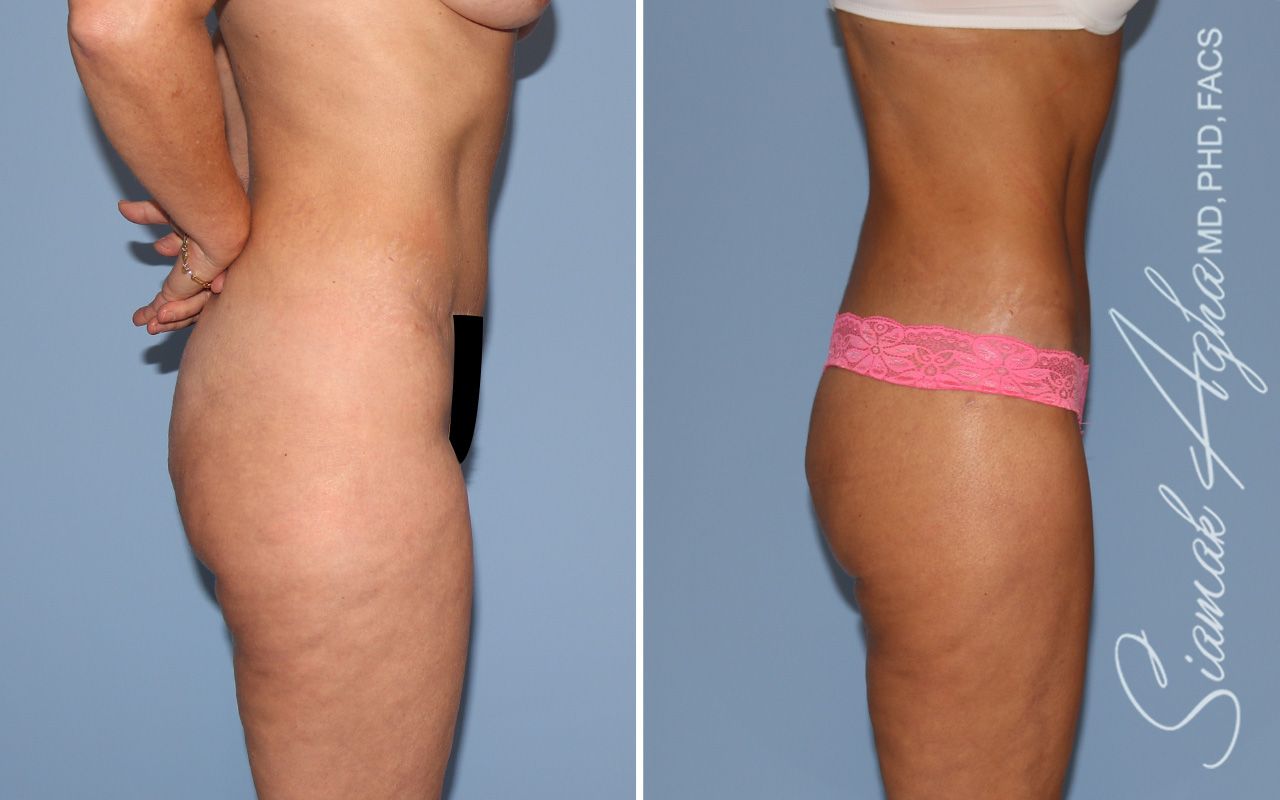 Lower Body Lift Before & After