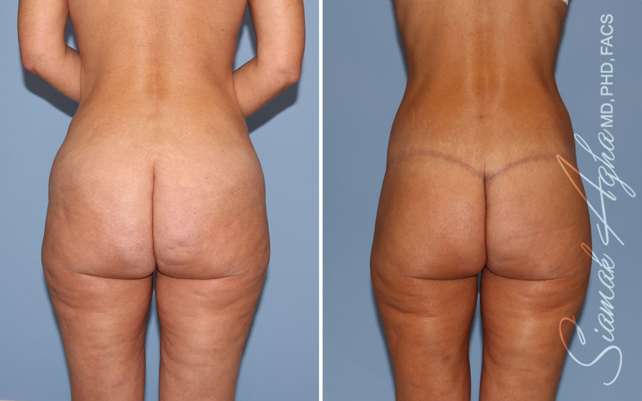 Lower Body Lift Before & After