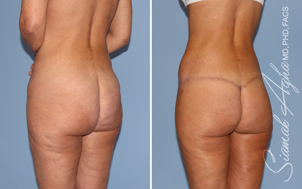 Lower Body Lift Before & After