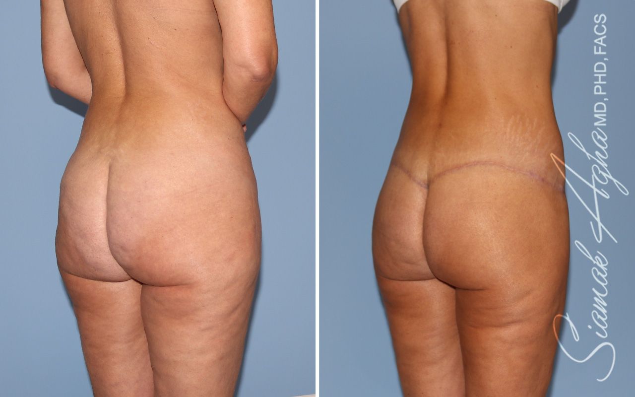 Lower Body Lift Before & After
