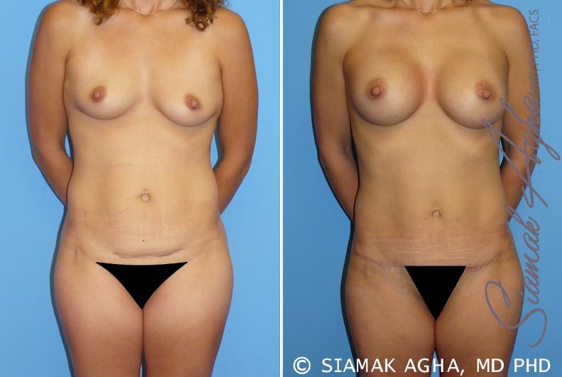Mommy Makeover Before & After