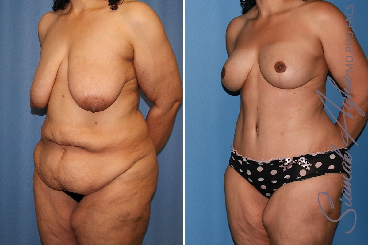 Mommy Makeover Before & After