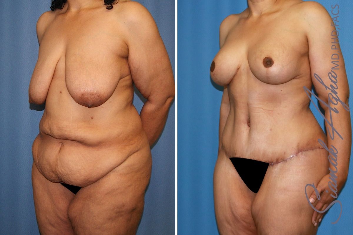 Mommy Makeover Before & After