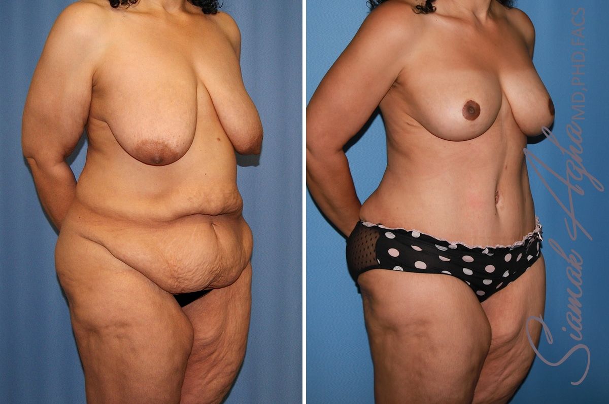 Mommy Makeover Before & After