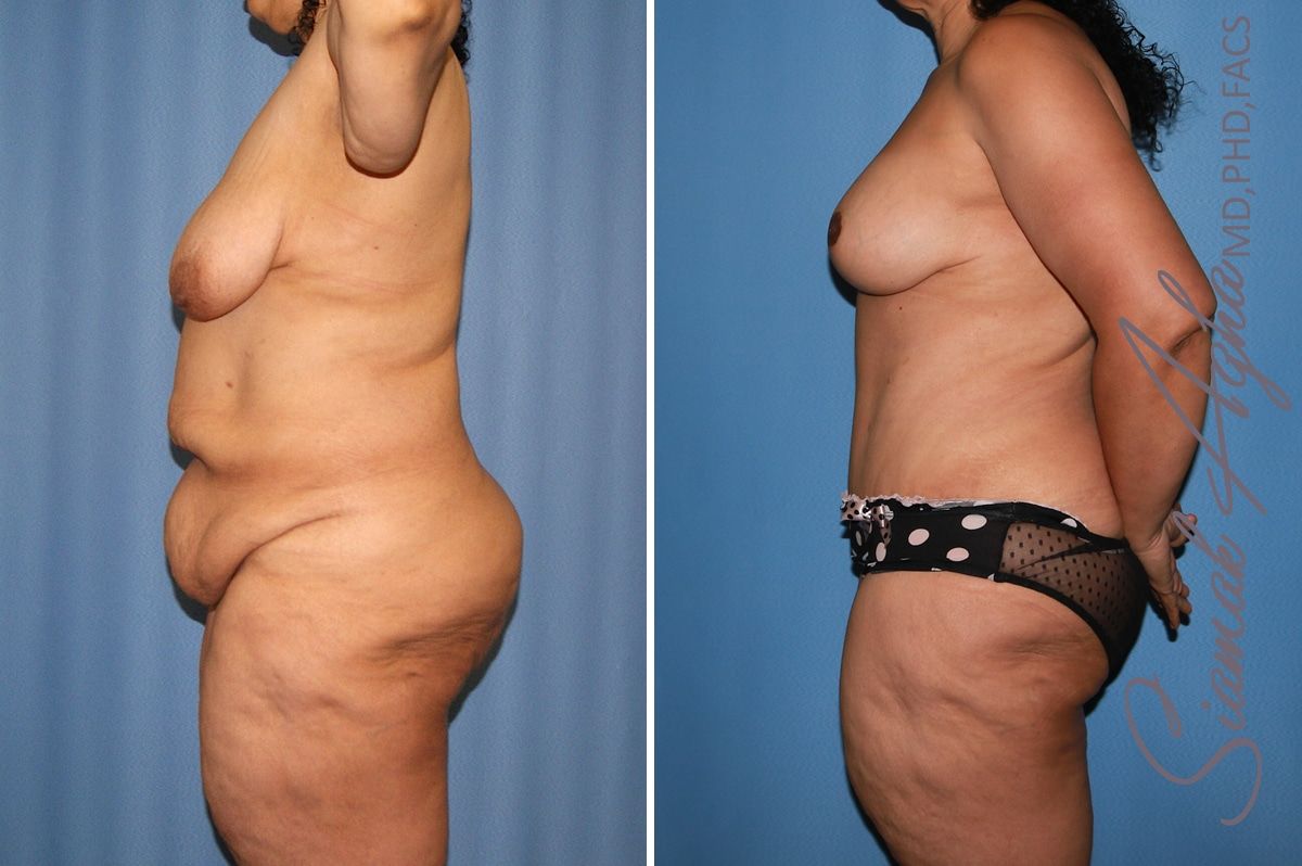 Mommy Makeover Before & After