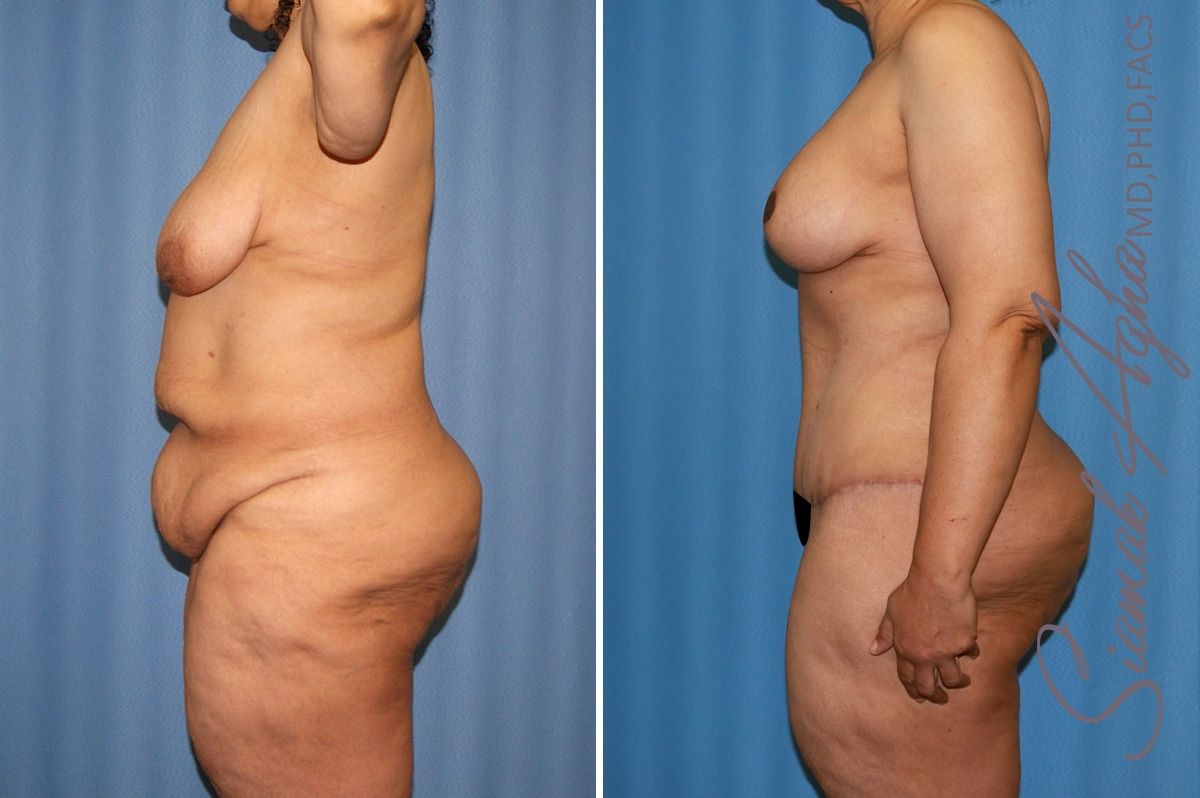 Mommy Makeover Before & After