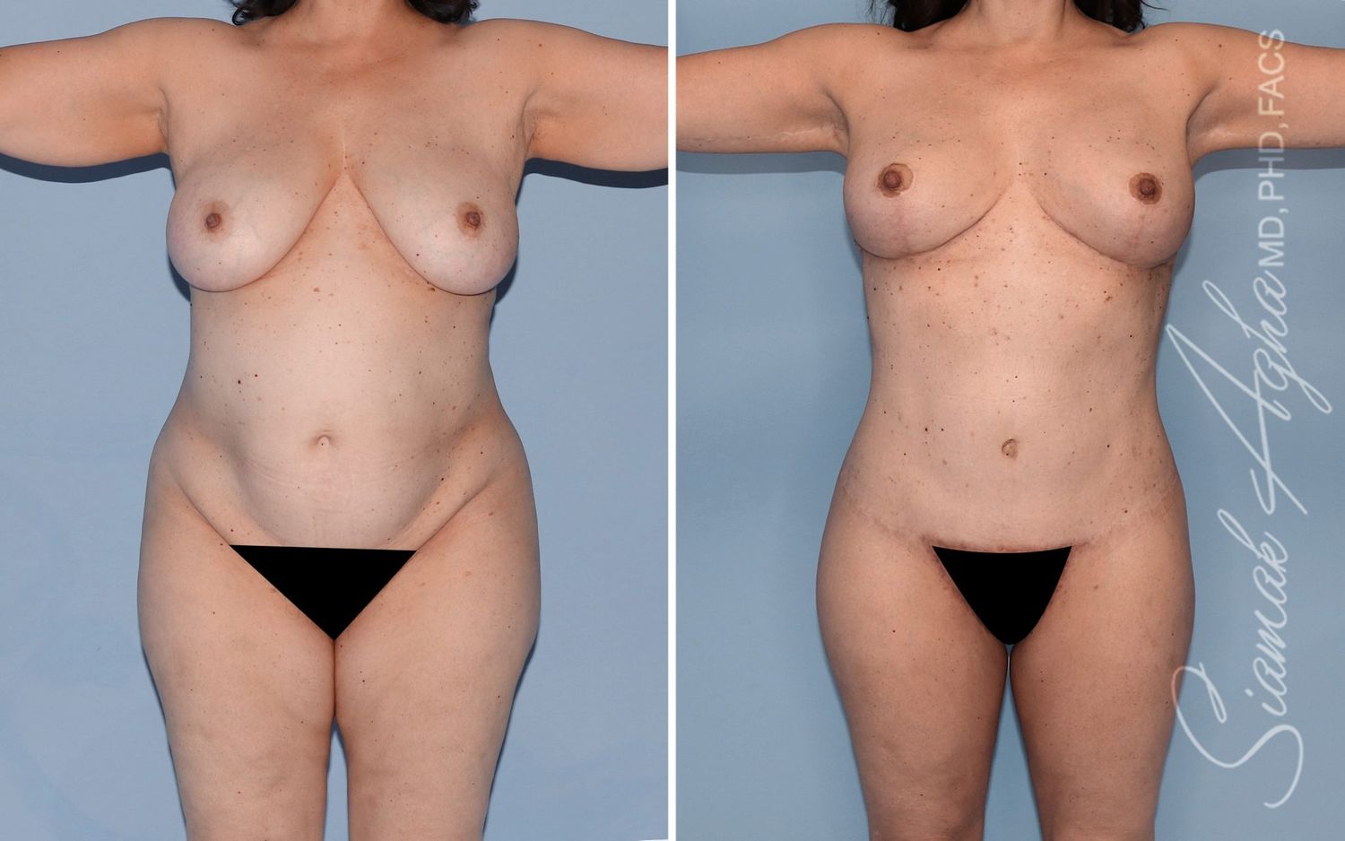 Mommy Makeover Before & After