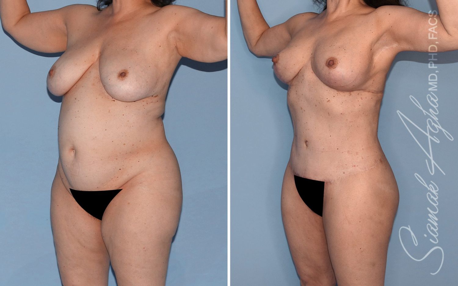 Mommy Makeover Before & After