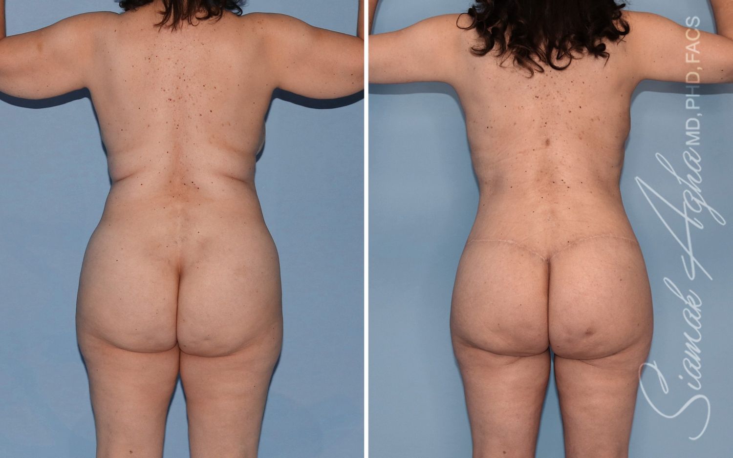 Mommy Makeover Before & After