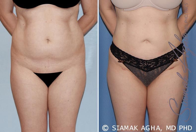 Brazilian Butt Lift Before & After