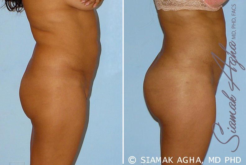 Brazilian Butt Lift Before & After