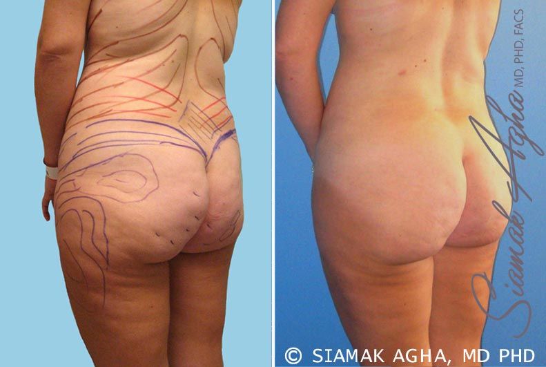 Brazilian Butt Lift Before & After