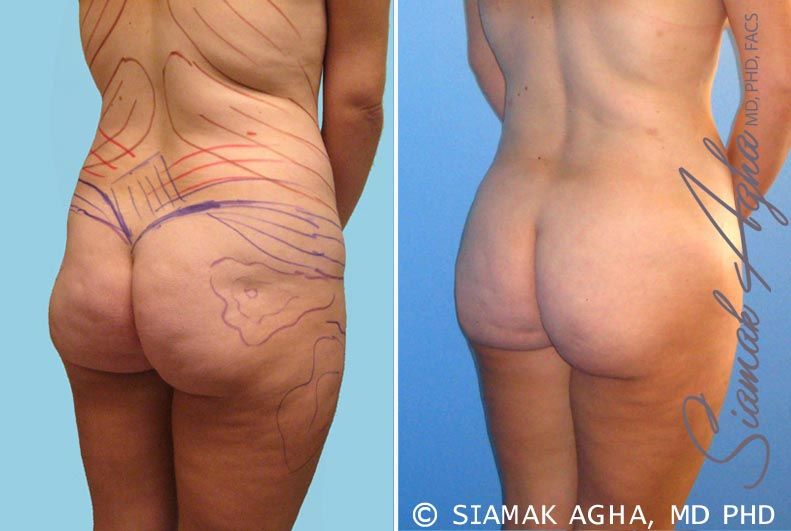 Brazilian Butt Lift Before & After