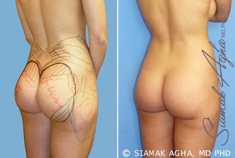 Brazilian Butt Lift Before & After