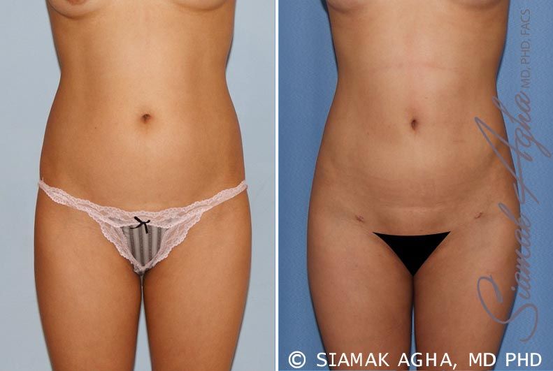 Brazilian Butt Lift Before & After