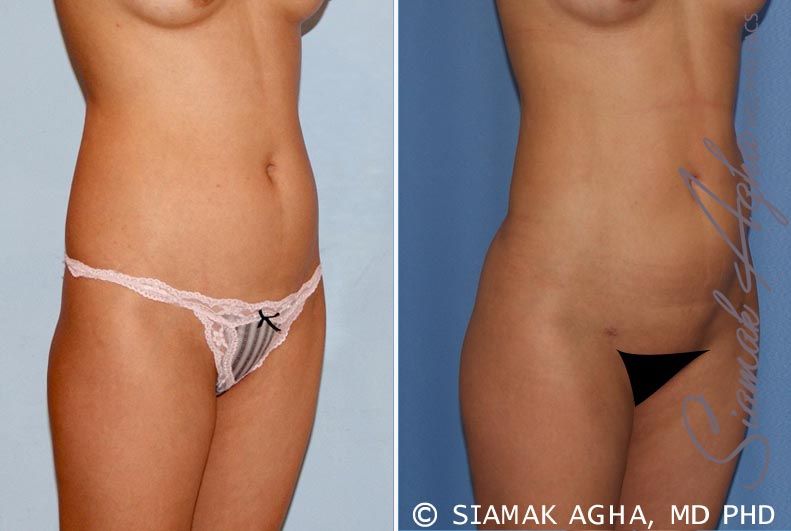 Brazilian Butt Lift Before & After