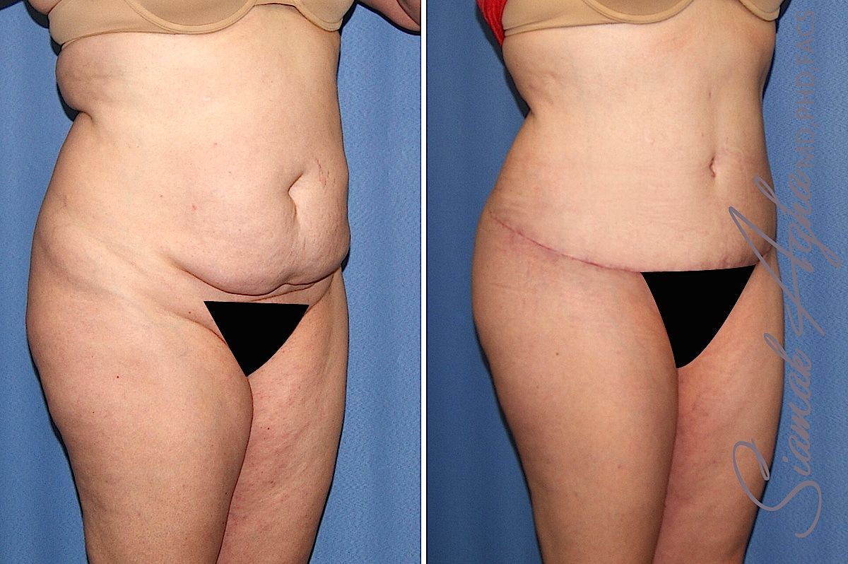 Brazilian Butt Lift Before & After