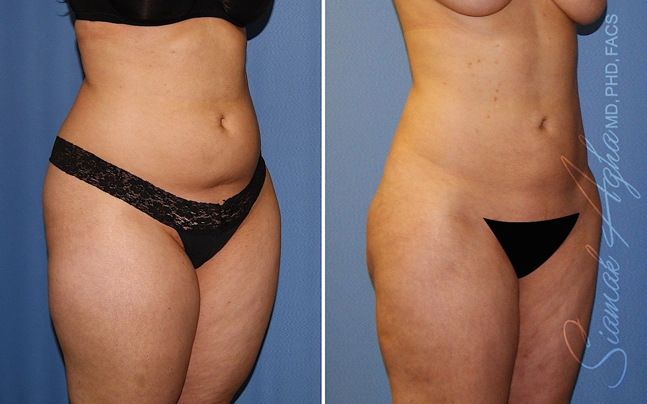 Brazilian Butt Lift Before & After