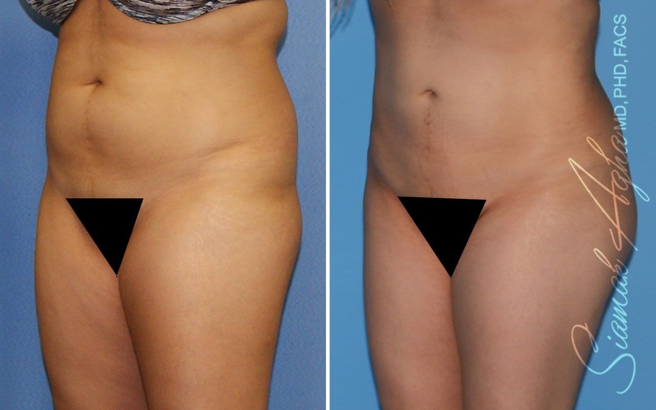 Brazilian Butt Lift Before & After