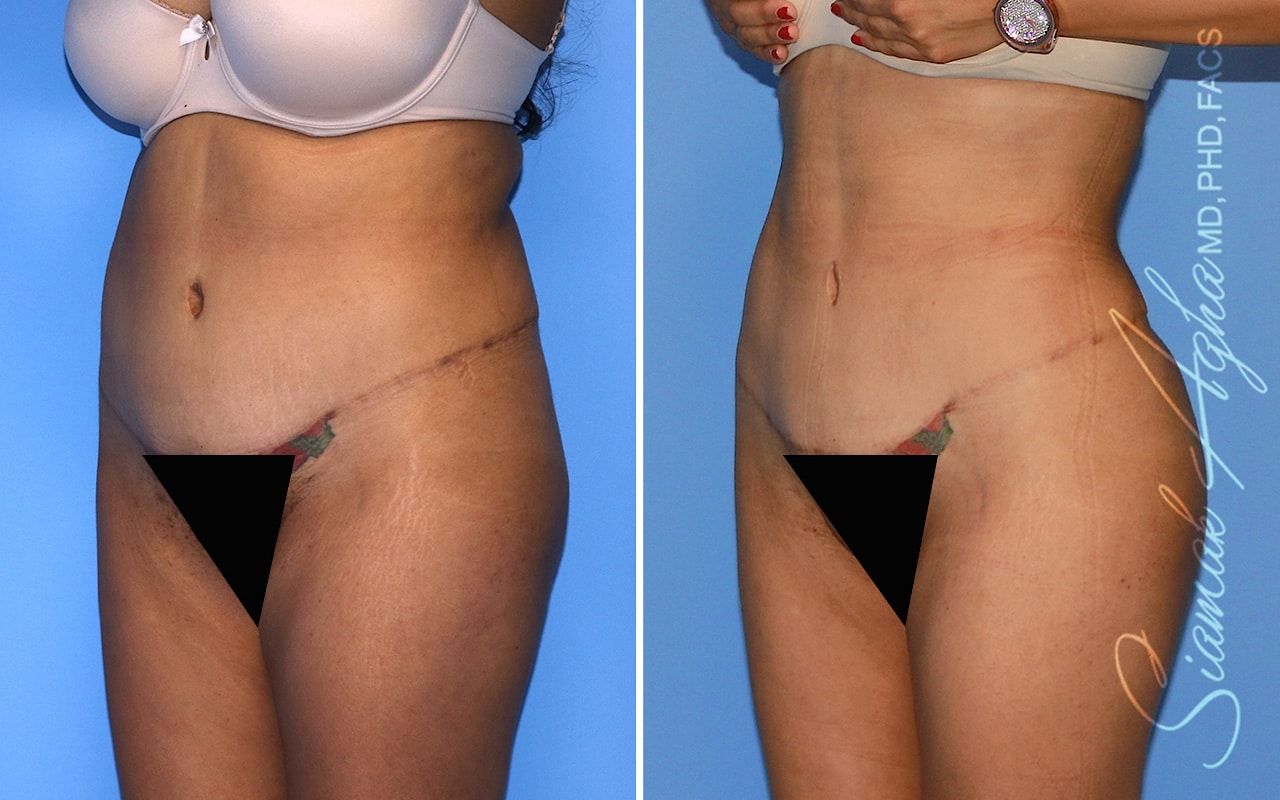 Brazilian Butt Lift Before & After